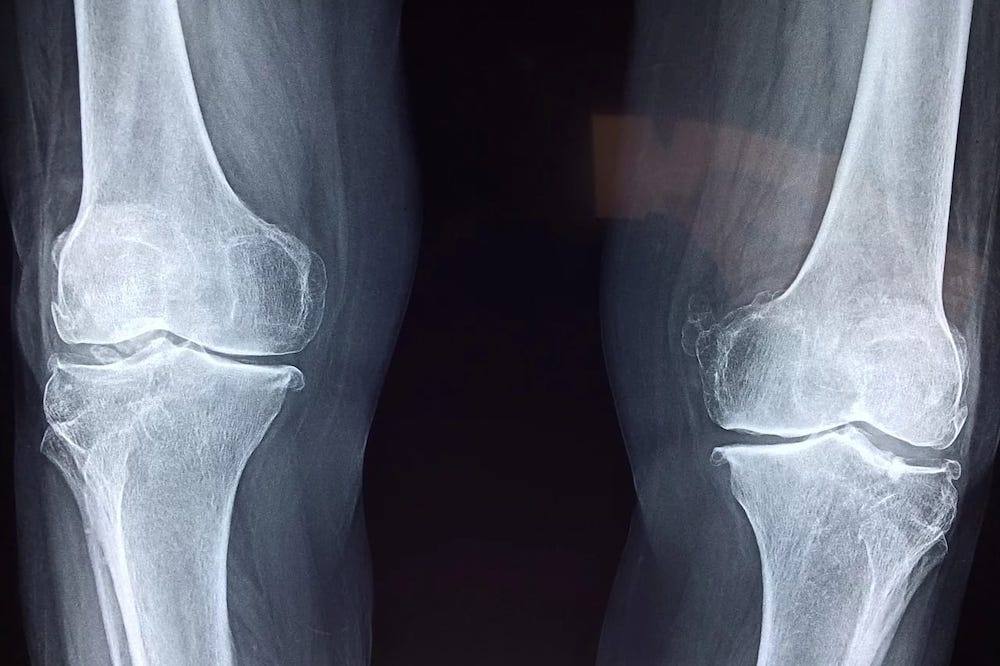 X-ray image of knee joints